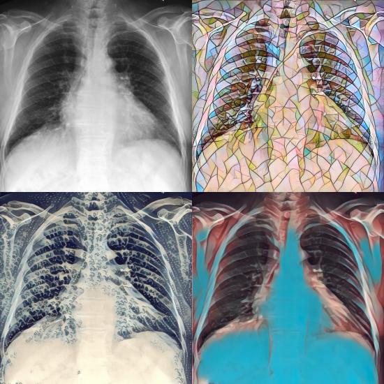 MIMIC-CXR Medical Imaging Project